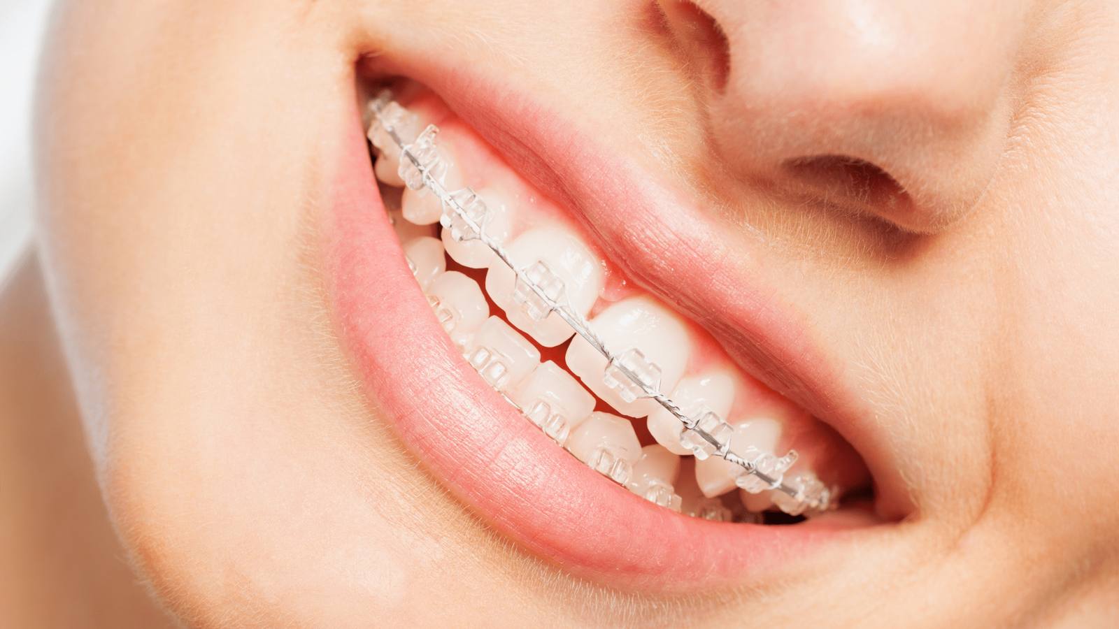 brackets son una solución de ortodoncia efectiva para cualquier edad
